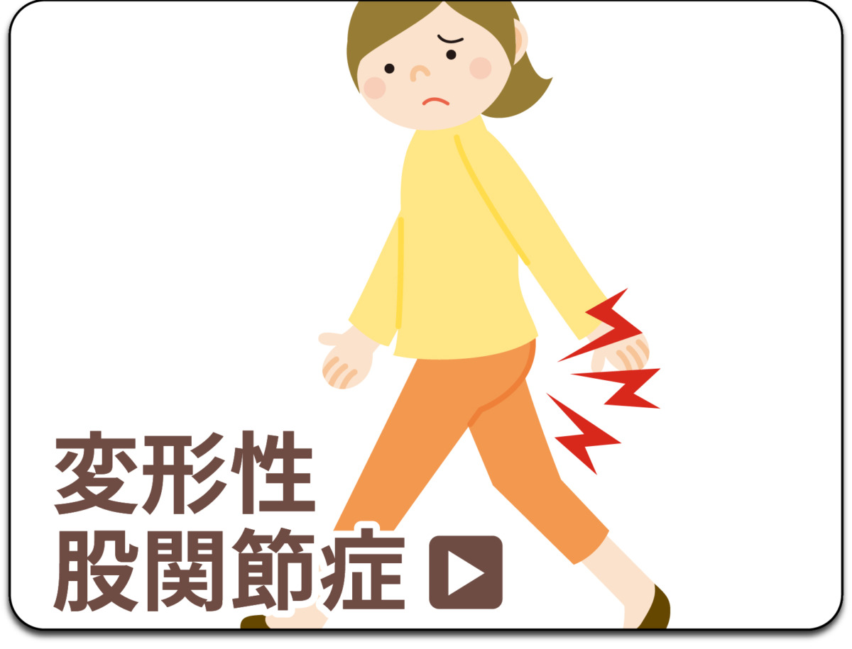 変形性股関節症