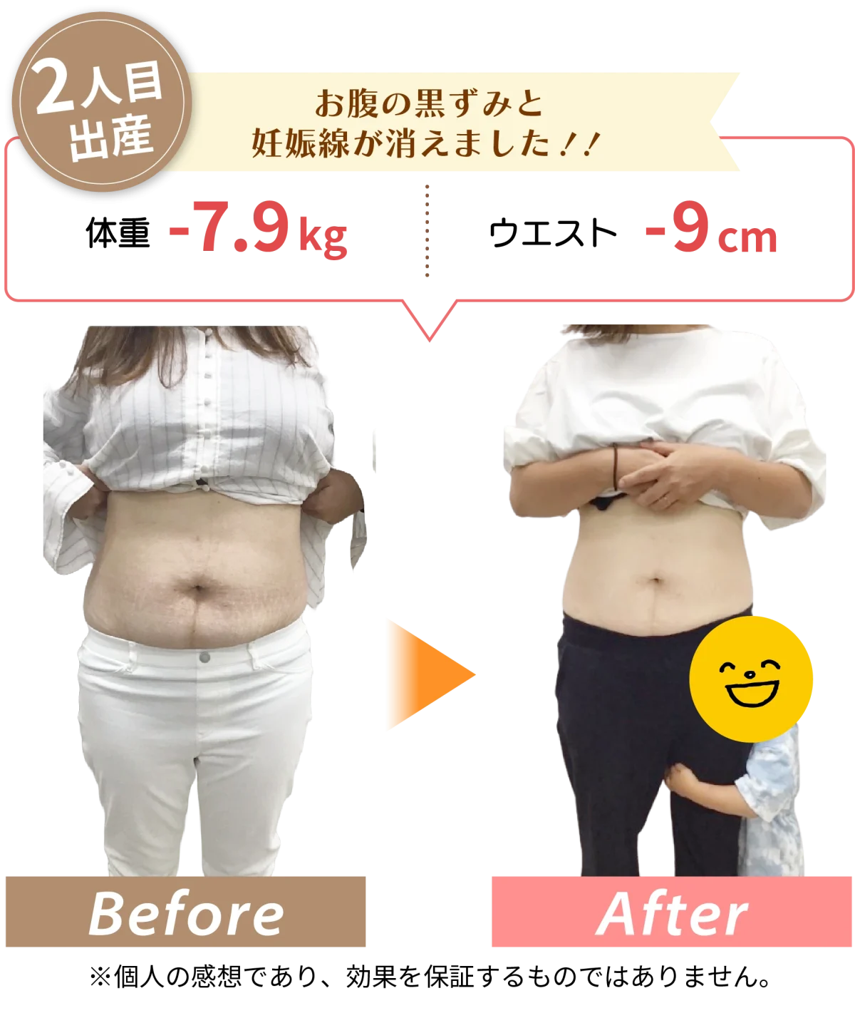 ビフォーアフター3 お腹の黒ずみと妊娠線が消えました!!